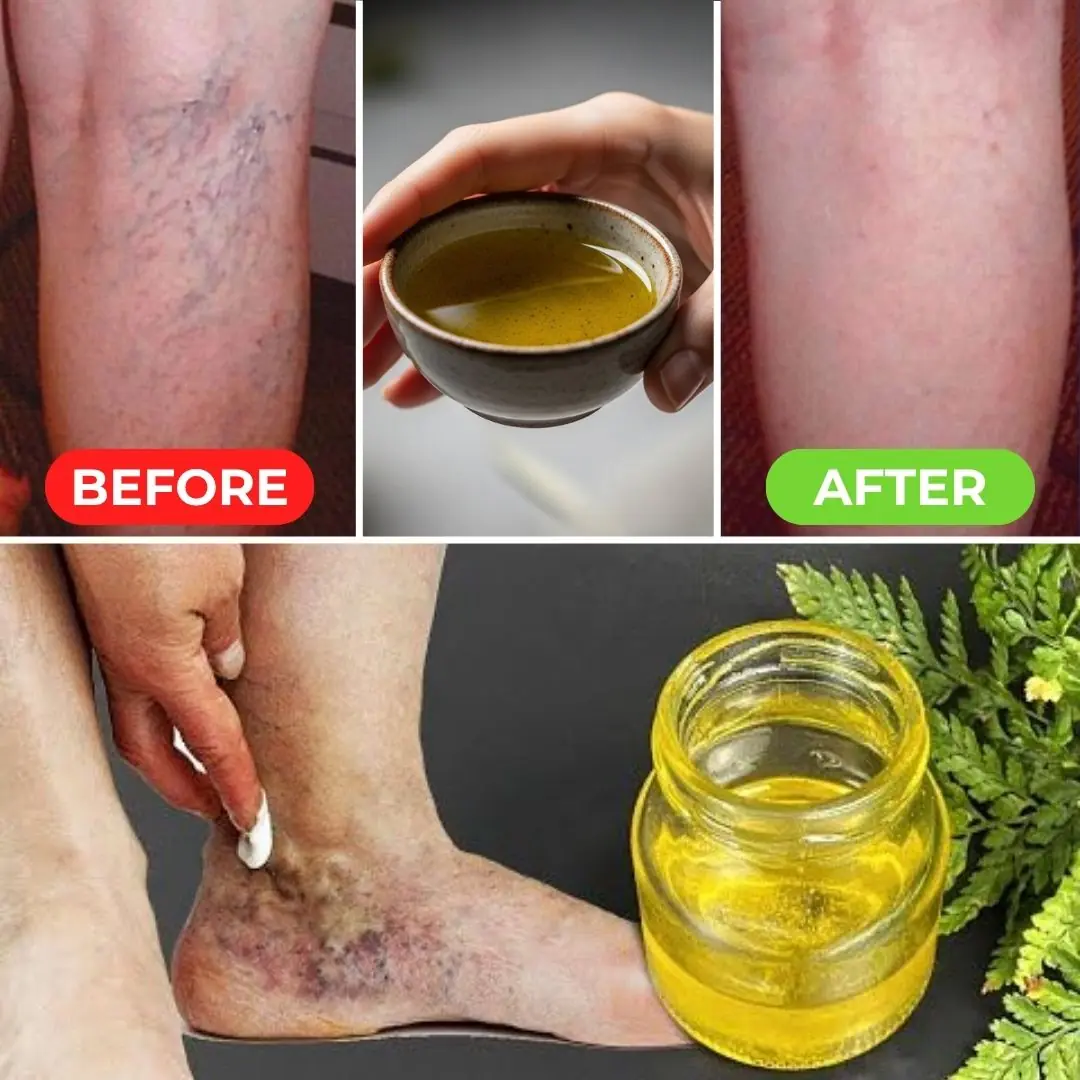 Say Goodbye to Varicose Veins Forever with This Simple Natural Oil!