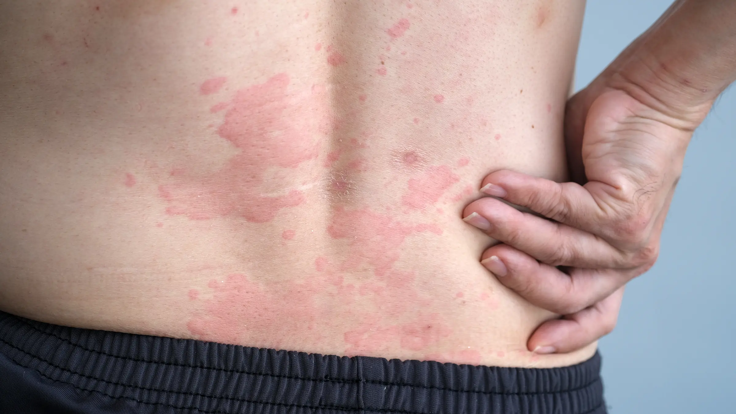 Surprising Triggers: What May Be Causing Your Hives (Urticaria)
