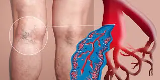 Blood Clot in Leg: Crucial Signs and Symptoms You Can't Afford to Ignore