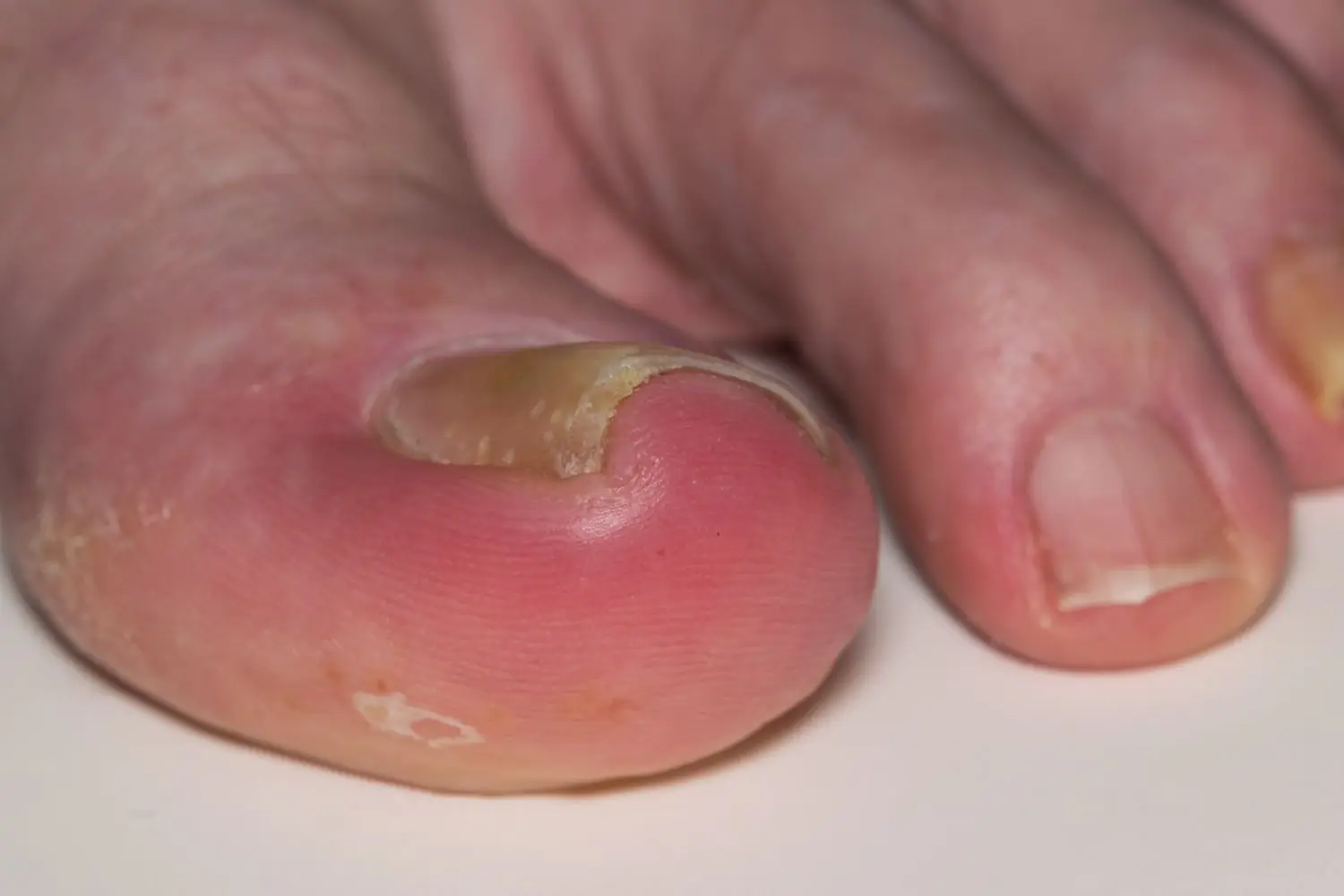 Home Remedies to Treat and Prevent Ingrown Toenails (Onychocryptosis)