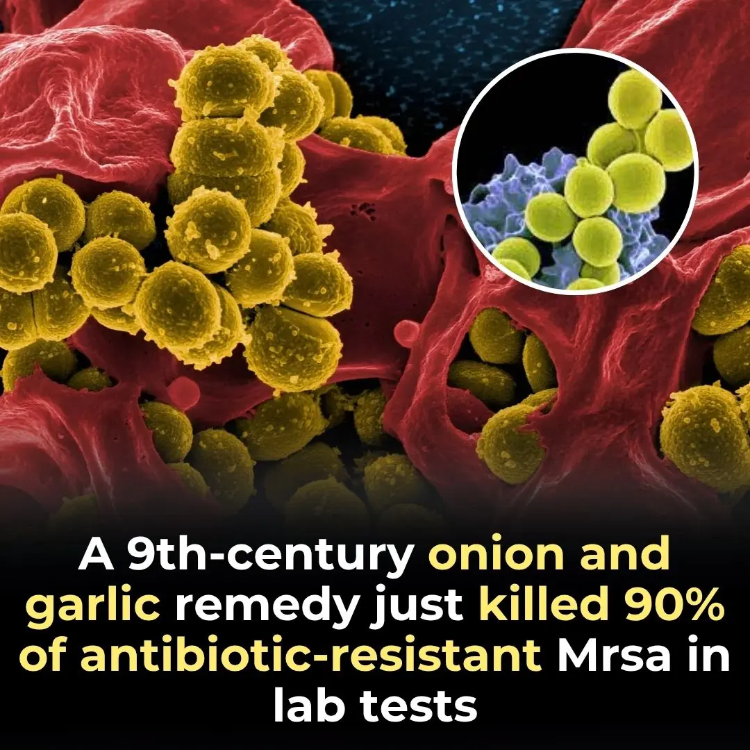 A 9th-century onion and garlic remedy just killed 90% of antibiotic-resistant MRSA in lab tests