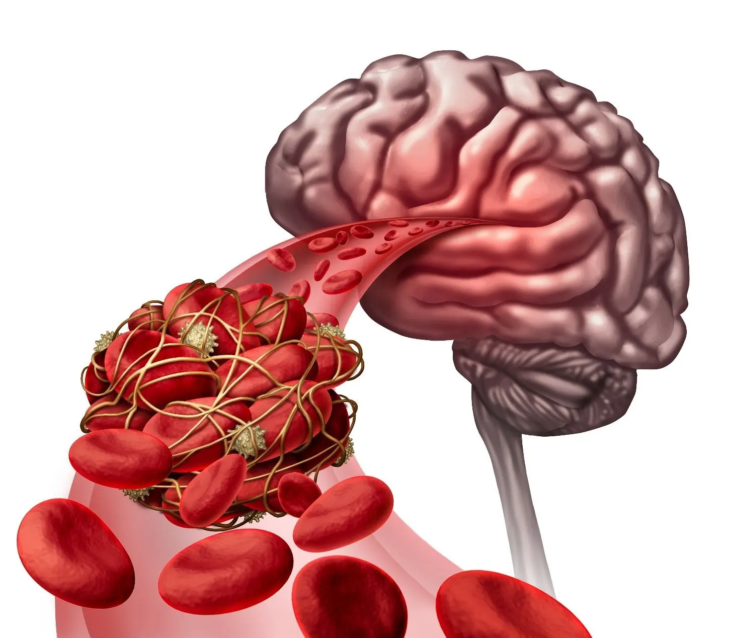 Warning signs of stroke 30 minutes before – remember them to save your life and your loved ones