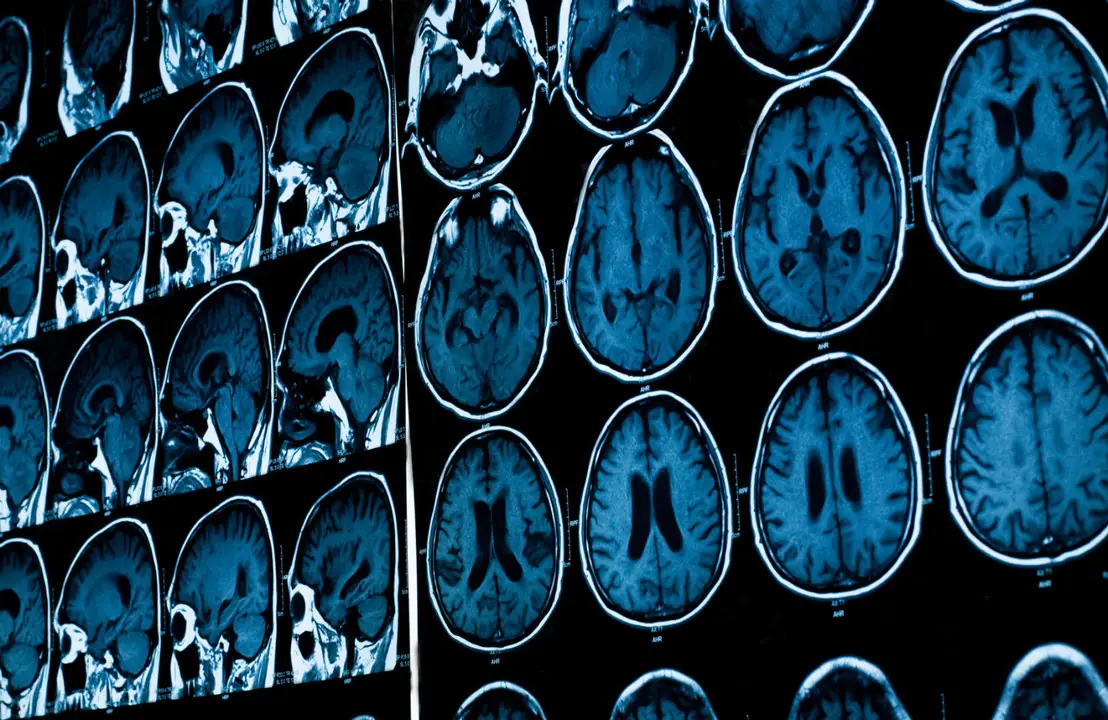 Alarming Discovery: High Aluminum Levels Found in Brains with Alzheimer's, Autism, and MS