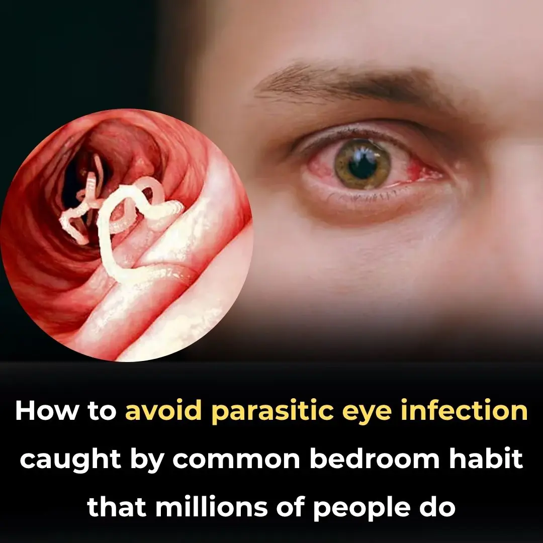 How to Avoid Parasitic Eye Infection Caught by Common Bedroom Habit That Millions of People Do