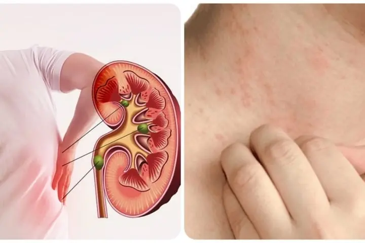 Clear Signs of Kidney Failure Everyone Should Pay Attention To
