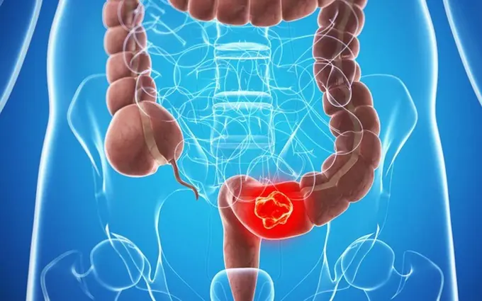 Warning Signs in Bowel Movements That May Indicate Colon Cancer – When to See a Doctor Immediately