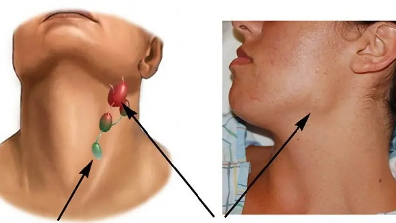 4 Unusual Signs in the Neck That Could Be Symptoms of Cancer – Don’t Ignore Them!