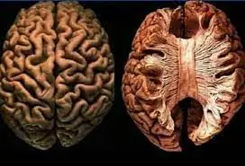 The Alarming Truth: Your Brain Literally Starts Eating Itself When You Don't Get Enough Sleep