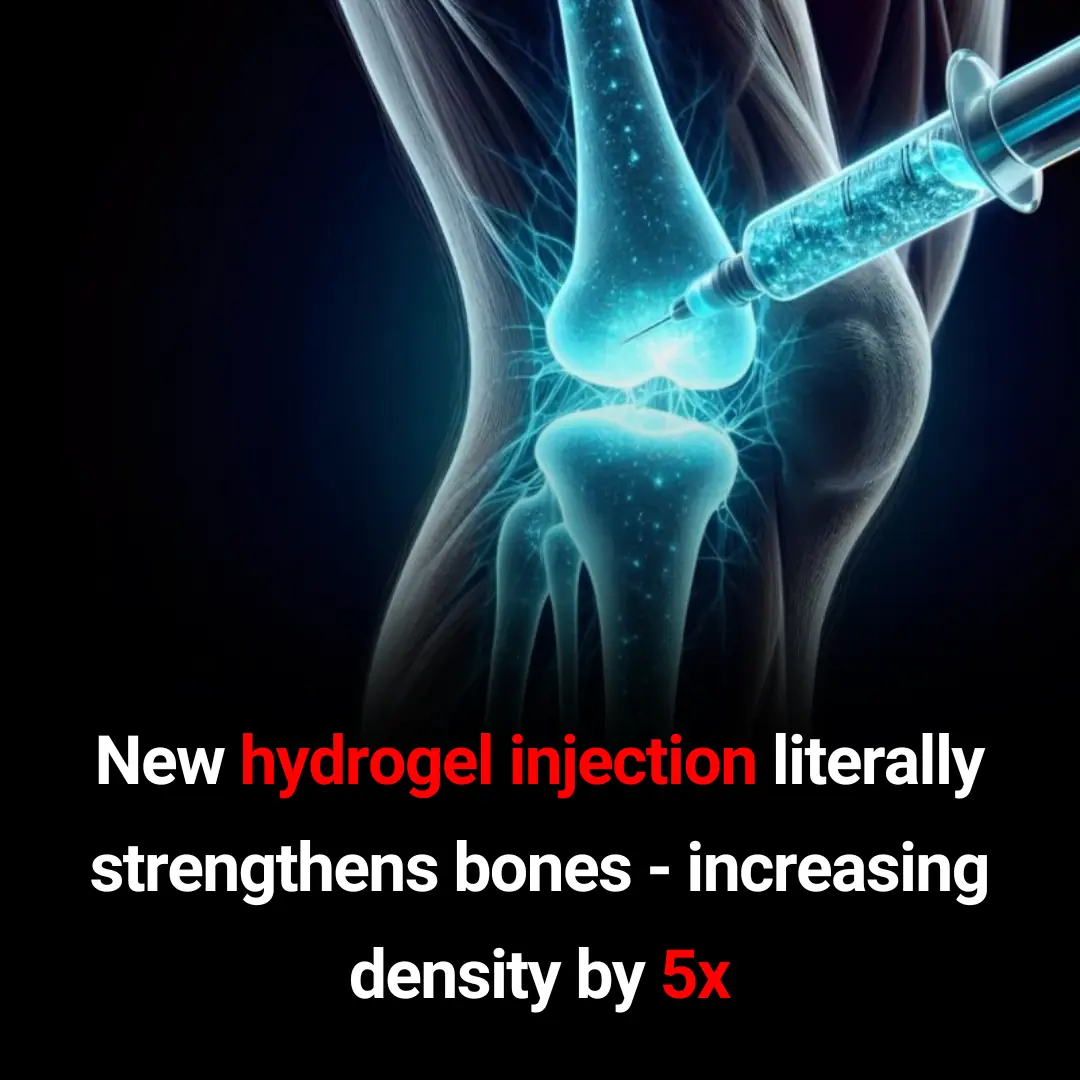 Injectable Hydrogel: A Game-Changer for Brittle Bones and Osteoporosis