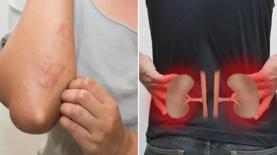 If Your Body Shows These 5 Signs, It Could Be a Warning of Kidney Disease or Impending Kidney Failure