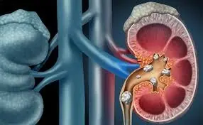5 Drinks That Can Help Dissolve Kidney Stones and Aid Easy Elimination