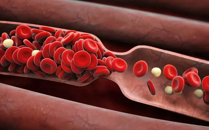 The Main Cause of Blood Clots Discovered – 10 Times Worse Than Fat!