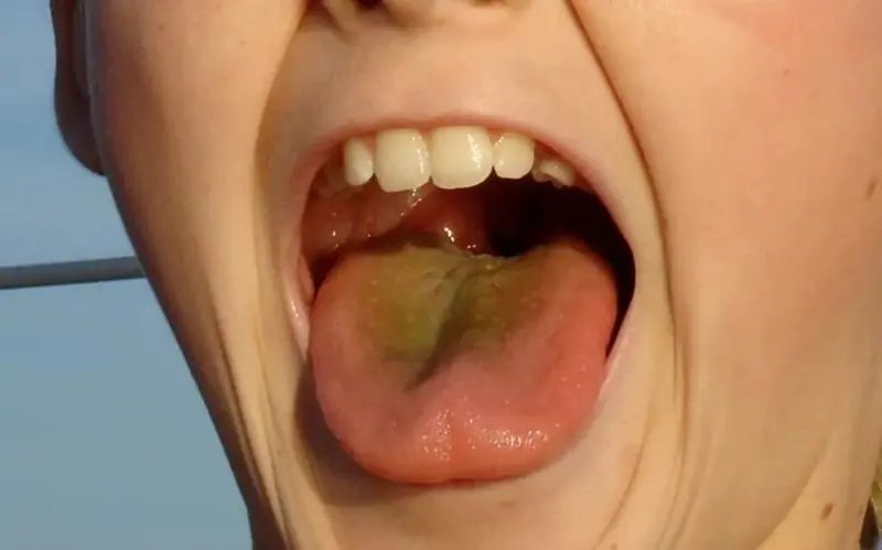 If Your Tongue Is Yellow, Be Cautious of These 5 Diseases