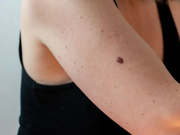 3 Mole Locations That Could Lead to Skin Cancer: A Warning Not to Ignore