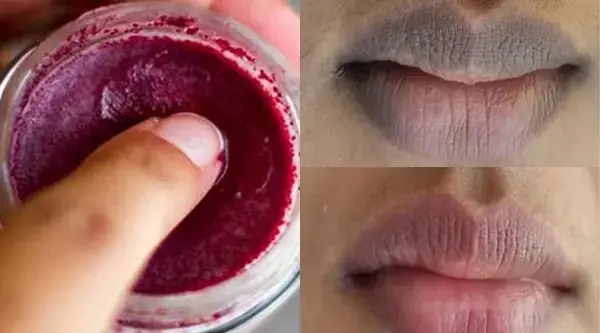 Lips De-Pigmentation Treatment At Home