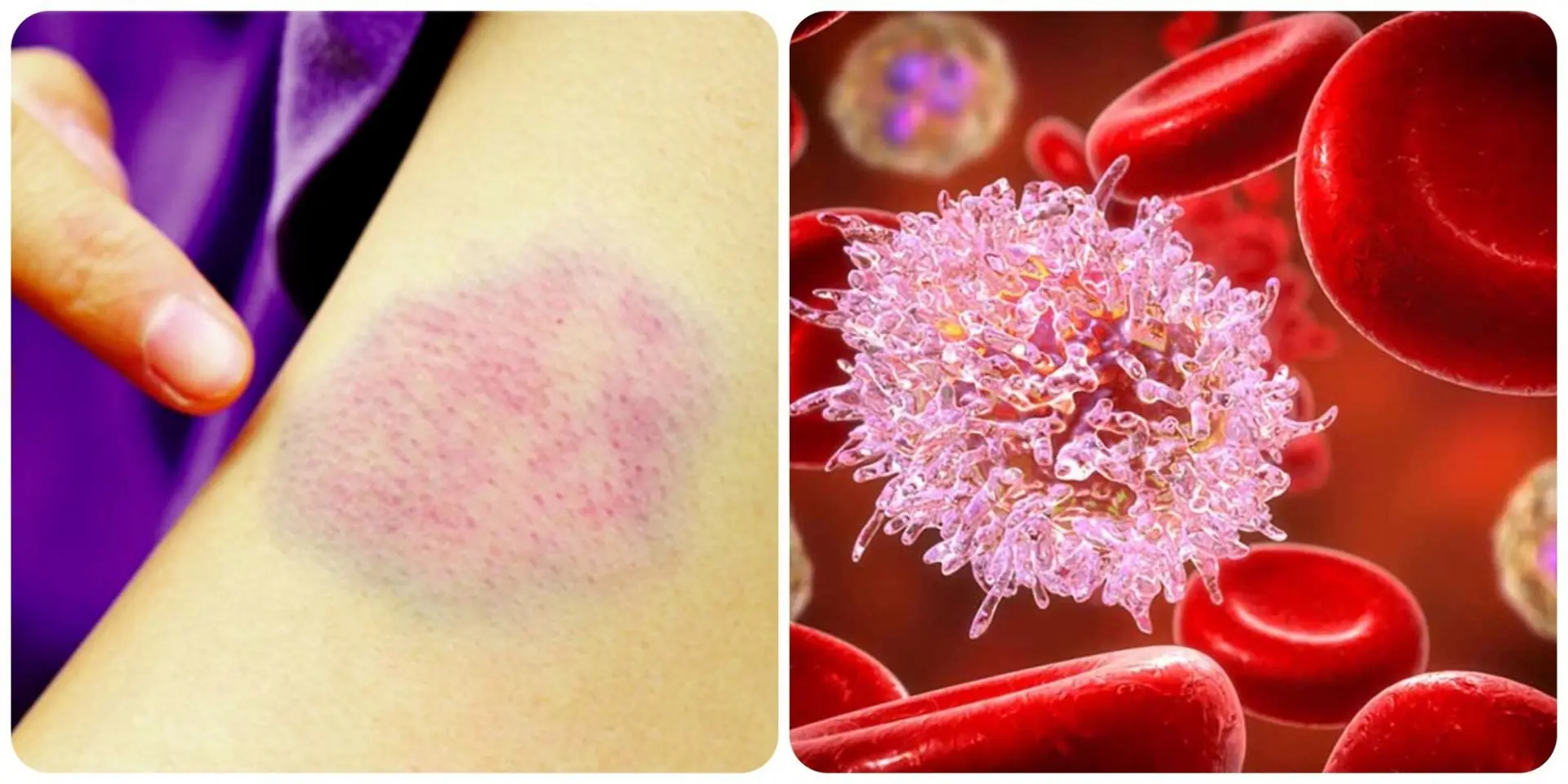 Before Cancer Knocks: 4 Signs on Your Hands and Feet Not to Be Ignored