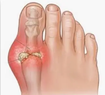 Natural Solutions for Gout: Tackling Uric Acid to Prevent Pain