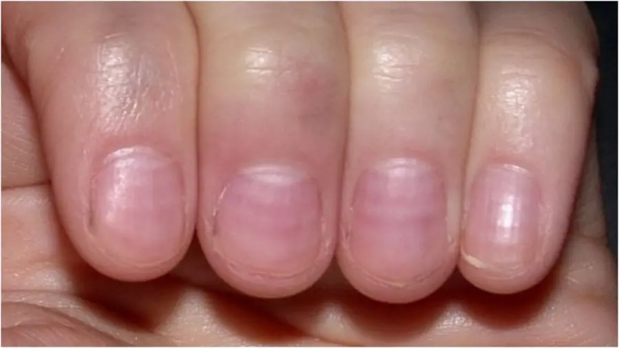 If Your Nails Show These Signs, Get Checked Immediately