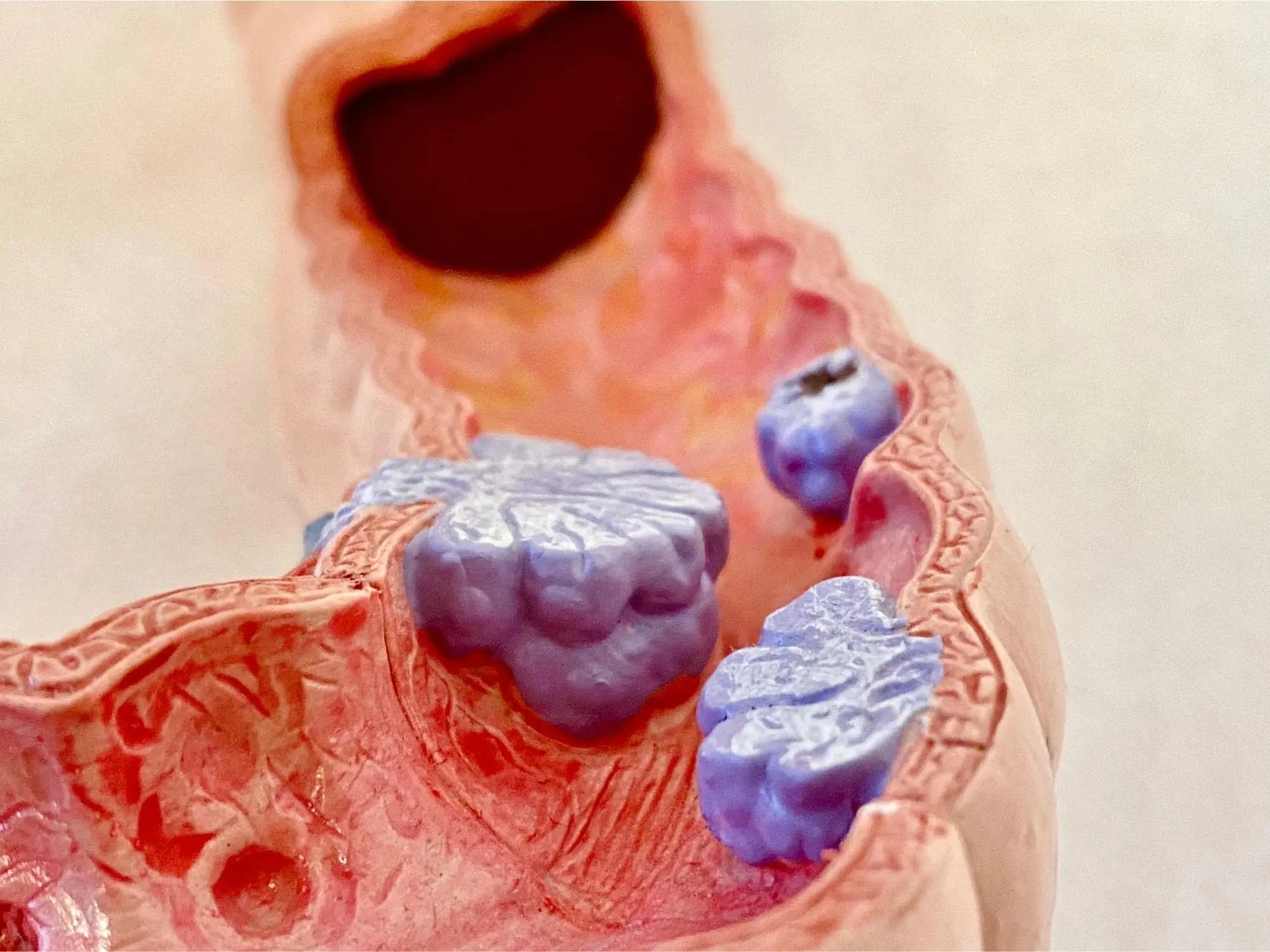 Stage 3 Colon Cancer Discovered Through a Symptom That Occurred 10 Times a Day