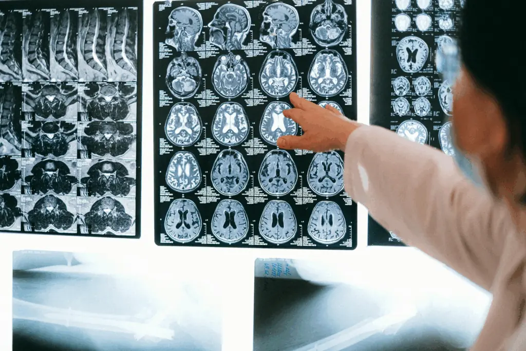 Warning Signs You Should Never Ignore: The Silent Symptoms Of A Brain Aneurysm