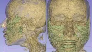 Doctor Reveals: MRI Scan Of The Face Of A 33-Year-Old Woman Reveals Where All Of Her Filler Went