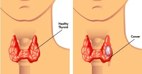 6 Types of Foods That Can Negatively Affect Your Thyroid