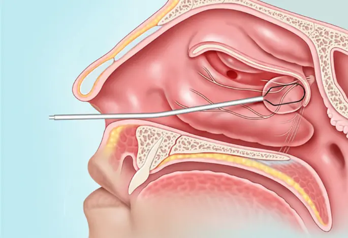 Home Remedies for Blocked and Stuffy Nose