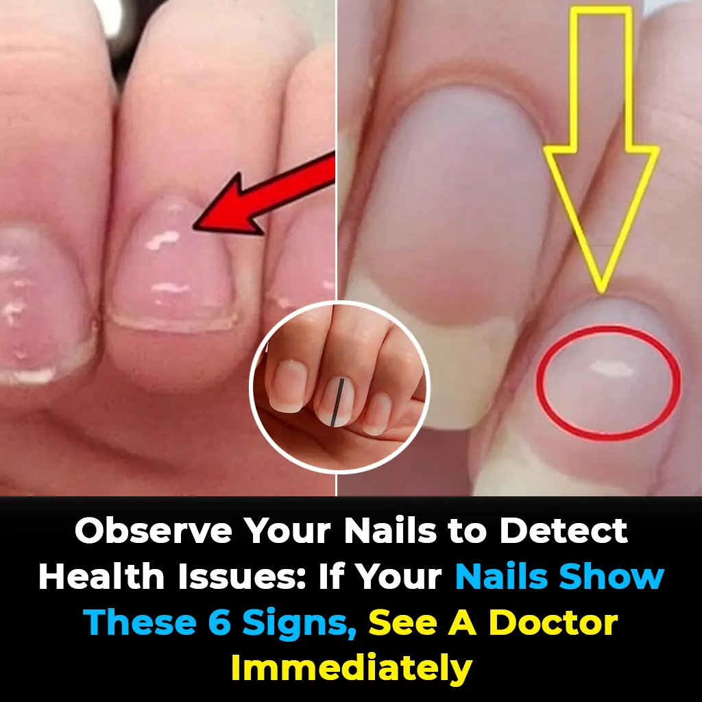 If Your Nails Show These 6 Signs, See a Doctor Immediately