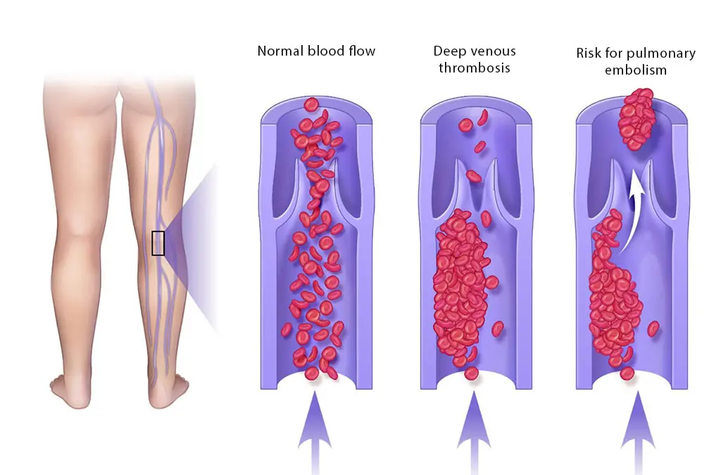Blood Clot in Leg: Signs and Symptoms You Shouldn’t Ignore