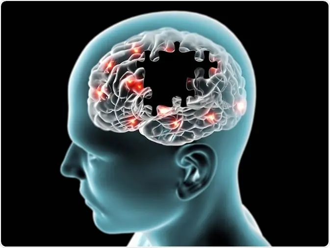 Groundbreaking Research: Reversing Memory Loss In Alzheimer’s Disease Without Removing Plaques