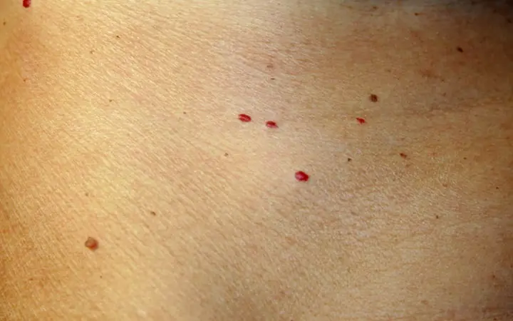 WHAT DO THESE RED DOTS ON YOUR SKIN MEAN?