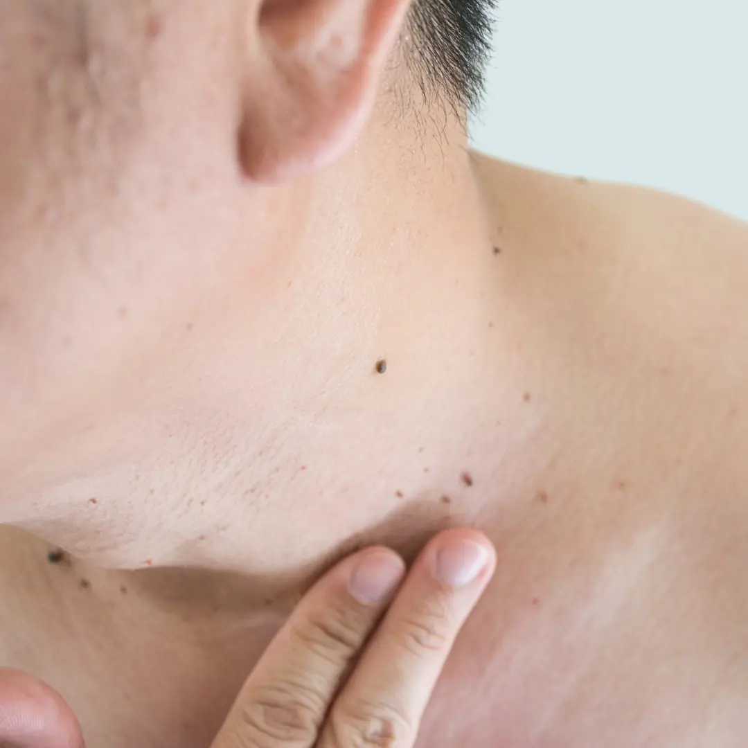 How to Remove Skin Tags and Warts Naturally and Cheaply at Home