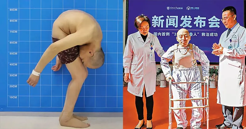 Man Folded In Half Stands Straight After 28 Years