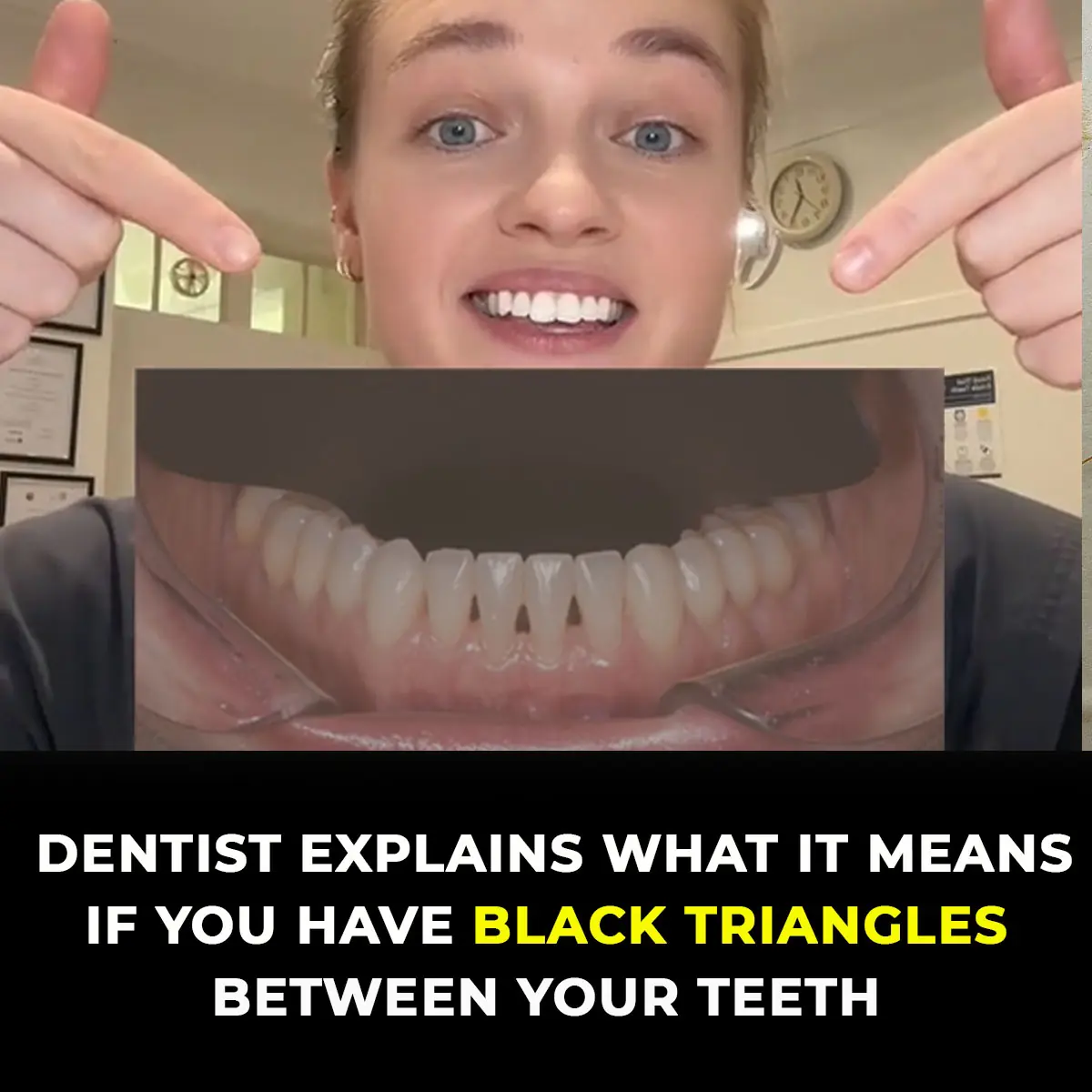 Dentists Explain What Those Black Triangles Are Between Your Teeth