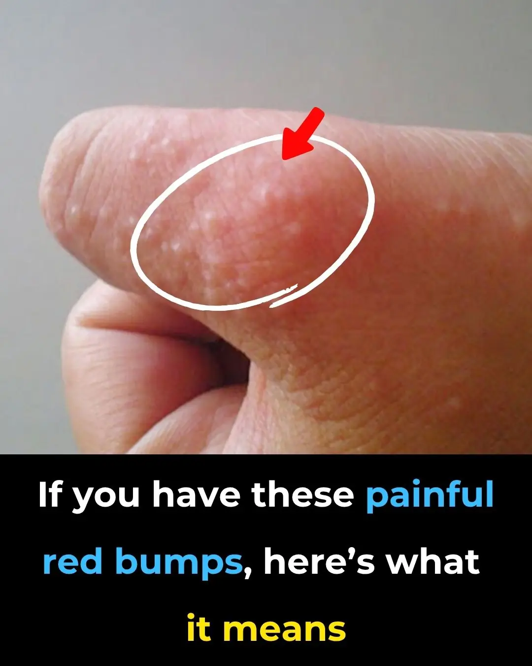 Painful Red Bumps on Skin? It Might Be Dyshidrotic Eczema