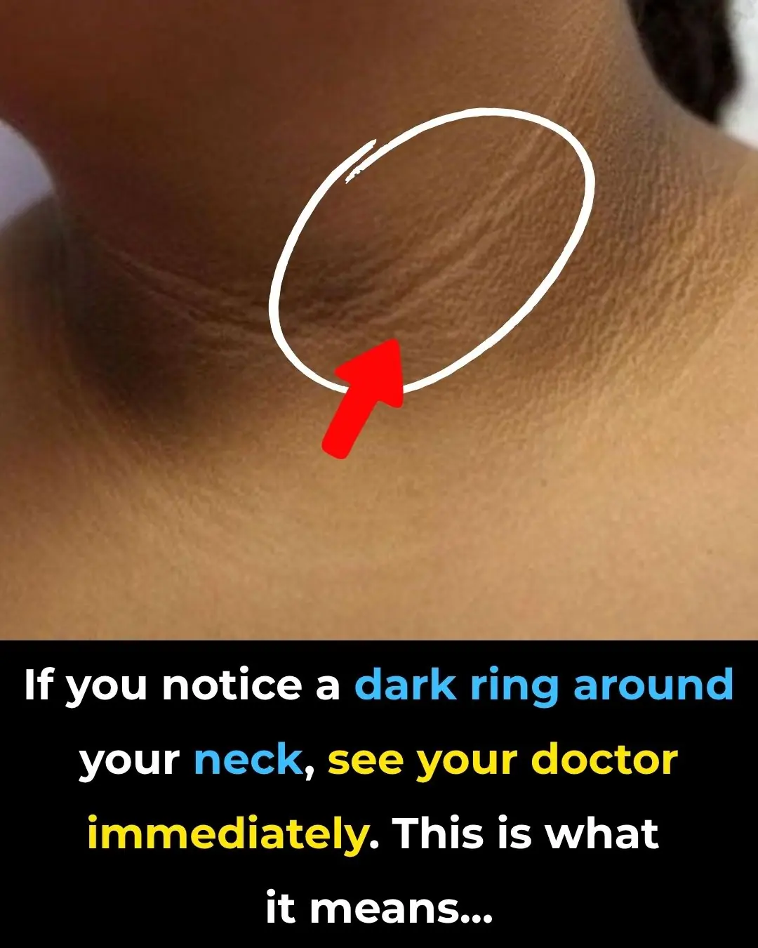 If You Notice a Dark Ring Around Your Neck, Go See Your Doctor Immediately! This Is What It Means