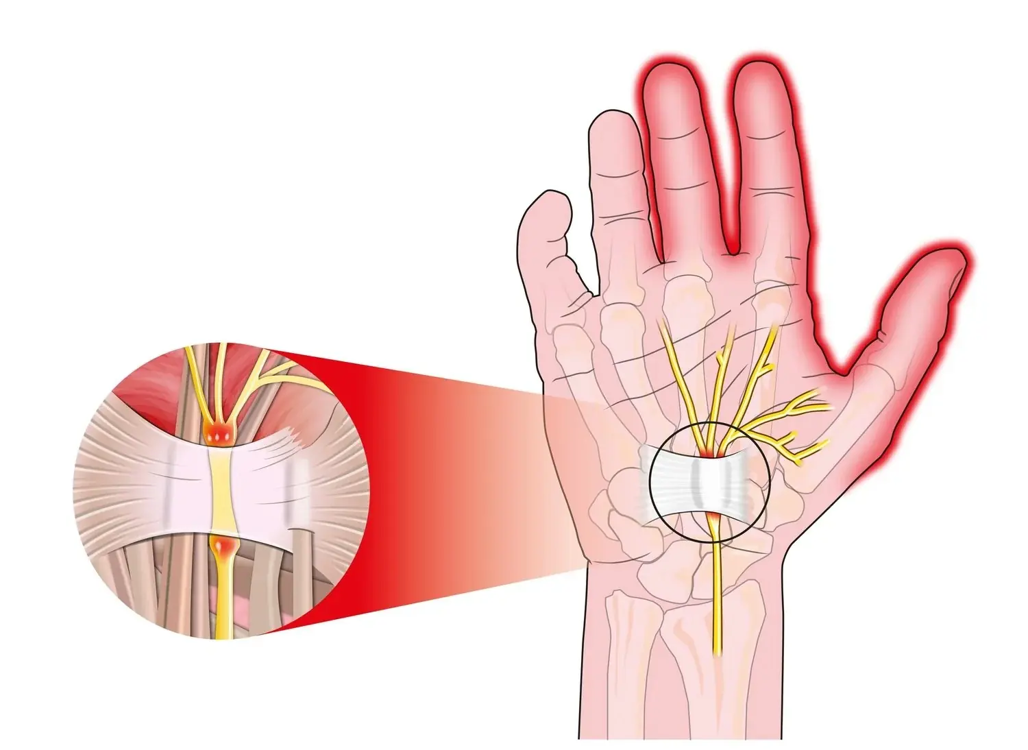 If Your Hands Keep Falling Asleep, It Might Be a Warning Sign of...