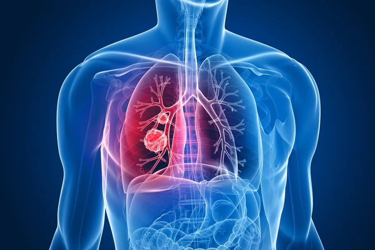 Vaping Dangers: Popcorn Lung, Cancer, Hypertension, Brain Damage and More