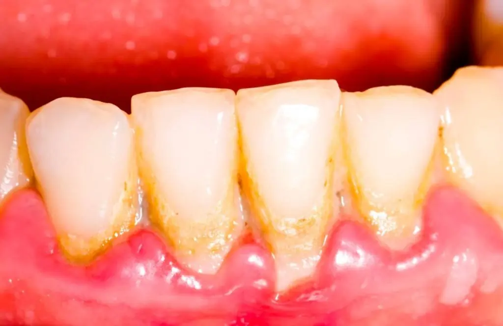 Natural Ways to Remove Dental Plaque That Are Never Shared in Clinics