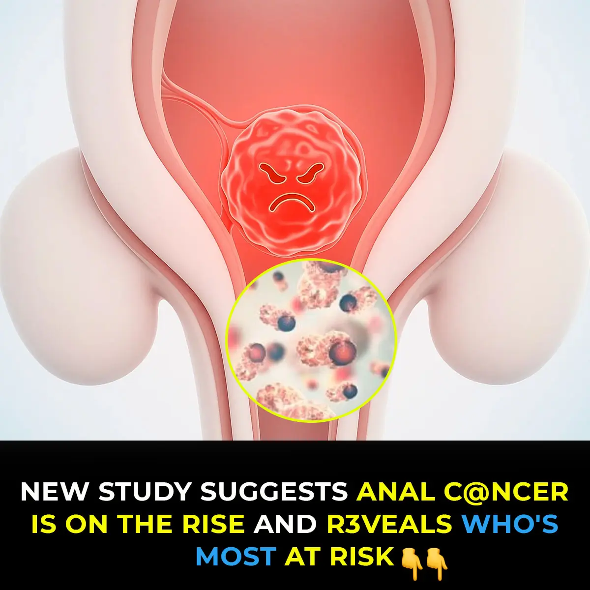 Researchers Sound Alarm Over Surge In Anal Cancer And High-Risk Populations