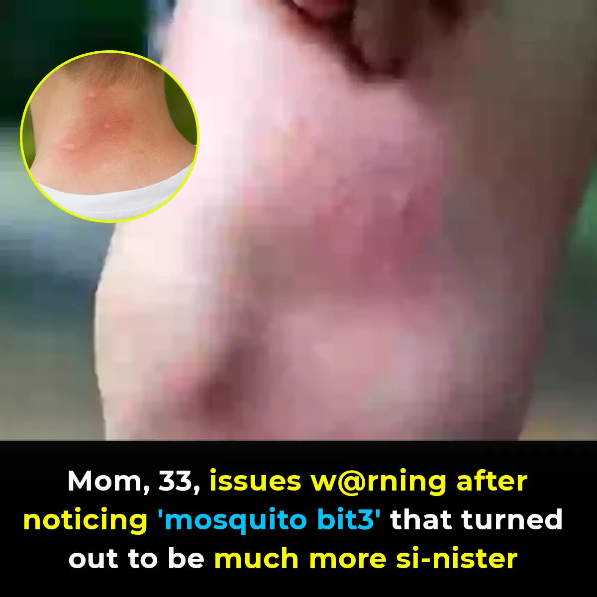 Mom, 33, issues warning after noticing ‘mosquito bite’ that turned out to be much more sinister