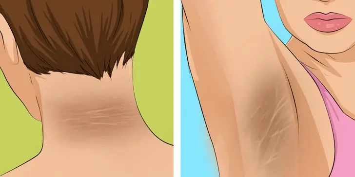 10 Warning Signs Sugar Is Slowly Wrecking Your Body