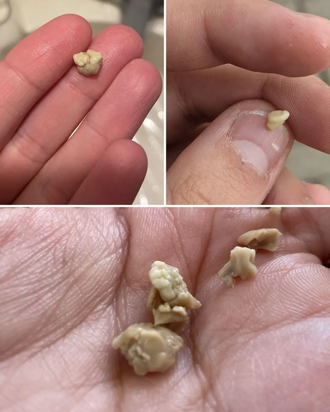 Tonsil Stones: Causes, Symptoms, and Natural Remedies