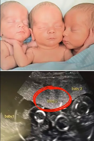 Mother Rushes To Emergency Room To Deliver Triplets: Then Nurses Look Closer At Their Faces And Freeze