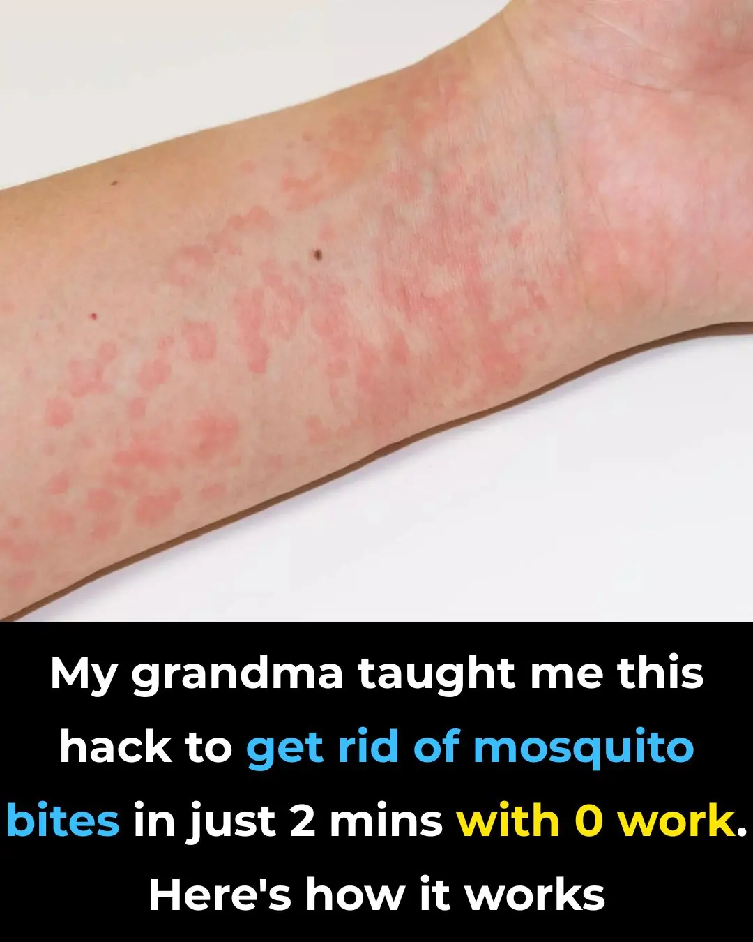 Doctors caution against viral hot spoon mosquito bite remedy