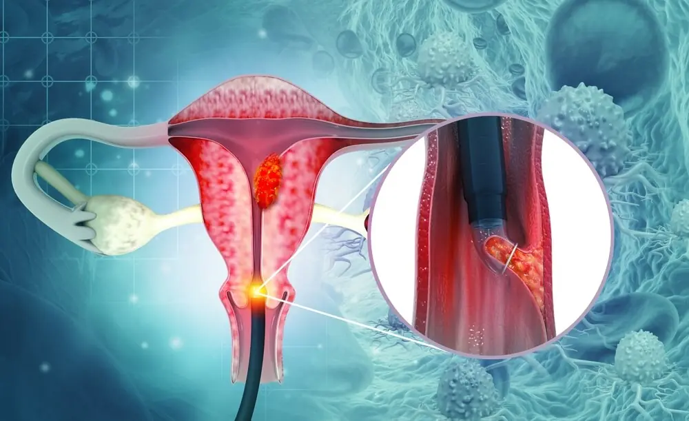 10 Warning Signs of Cervical Cancer You Shouldn’t Ignore
