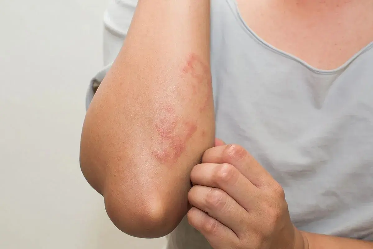 Gluten Intolerance Warning: Eczema and Other Hidden Signs Revealed