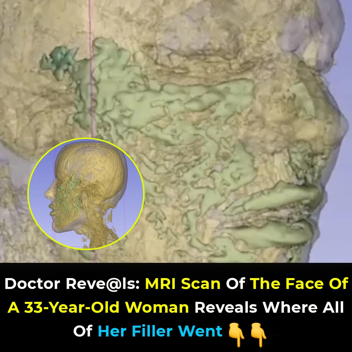 Doctor Reveals: MRI Scan Of The Face Of A 33-Year-Old Woman Reveals Where All Of Her Filler Went