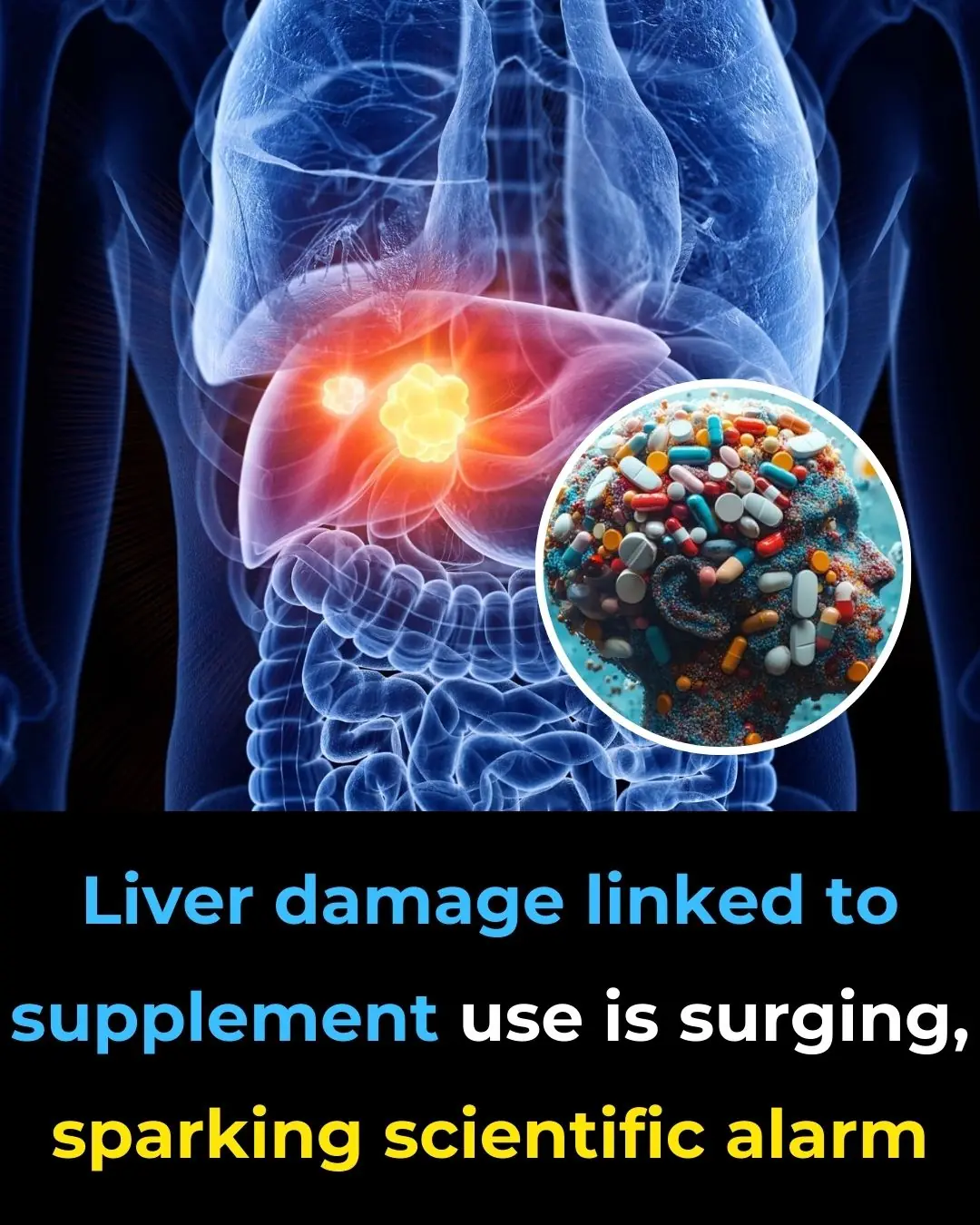 Liver Damage Linked to Supplement Use Is Surging, Sparking Scientific Alarm