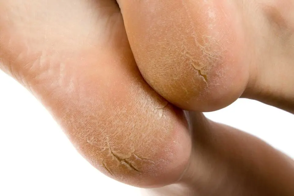 How to Get Rid of Dead Dry Skin on Feet